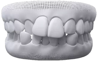 Modelo 3D de arcada com dentes apinhados