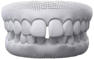 Modelo 3D de arcada com diastema, espaço entre os dentes da frente